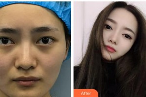 武漢佰視達(dá)眼科門診部趙青華整形價(jià)格表附眼部修復(fù)案例展示