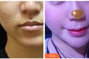 黃石市中心醫(yī)院整形外科步長龍整形價(jià)格表附埋線提升案例展示