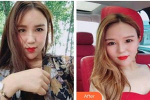 黃石市第五醫(yī)院整形外科可國安整形價(jià)格表附超聲提拉案例展示