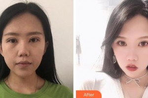 黃石中愛醫(yī)療美容門診部祁向峰整形價(jià)格表附埋線提升案例展示