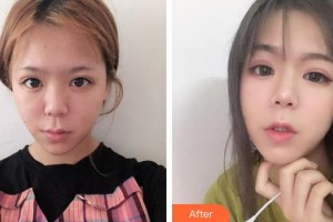 黃石市中心醫(yī)院整形外科萬文勇整形價(jià)格表附熱拉提案例展示