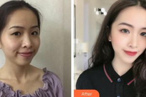 黃石市第五醫(yī)院整形外科丁若虹整形價(jià)格表附熱拉提案例展示