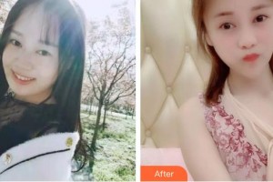 黃石市中心醫(yī)院整形外科沈健整形價(jià)格表附埋線提升案例展示