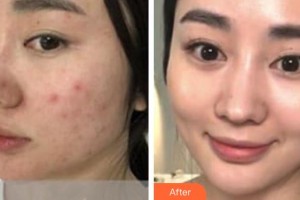 黃石華中福康醫(yī)院（華中.華美）張智珍整形價(jià)格表附黃金微針案例展示