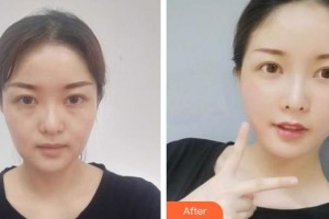 黃石華中?？滇t(yī)院（華中.華美）曹英武整形價(jià)格表附埋線提升案例展示