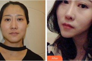 黃石市中心醫(yī)院整形外科金志福整形價格表附埋線提升案例展示