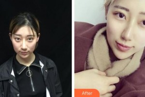 黃石華中?？滇t(yī)院（華中.華美）余秋芬整形價格表附埋線提升案例展示