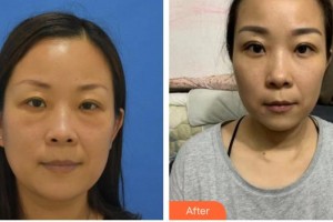黃石愛爾眼科醫(yī)院曹剛琴整形價格表附切開雙眼皮案例展示