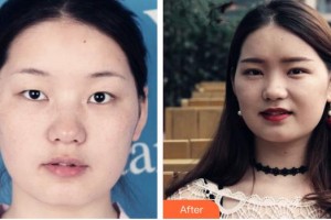 黃石愛爾眼科醫(yī)院汪建整形價格表附切開雙眼皮案例展示