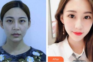 黃石愛爾眼科醫(yī)院陳洋整形價格表附內(nèi)切祛眼袋案例展示