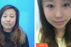 黃石愛爾眼科醫(yī)院吳海政整形價格表附眼部綜合案例展示