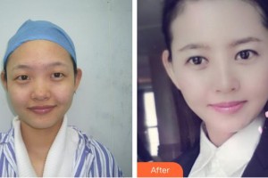 黃石愛爾眼科醫(yī)院程國旺整形價格表附眼部綜合案例展示