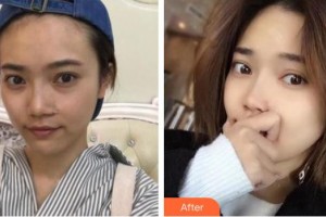 黃石愛爾眼科醫(yī)院朱劍整形價格表附內(nèi)切祛眼袋案例展示