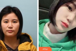 黃石愛爾眼科醫(yī)院葉明整形價格表附埋線雙眼皮案例展示