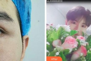 黃石愛爾眼科醫(yī)院柯國梁整形價格表附眼部綜合案例展示