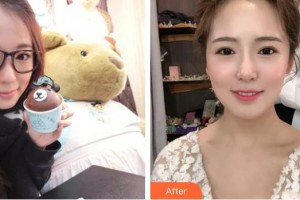 黃石現(xiàn)代口腔醫(yī)院陳琪整形價格表附美白貼片案例展示