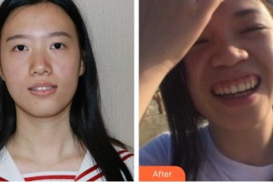 黃石中山口腔醫(yī)院馮濤整形價格表附隱形托槽矯正案例展示