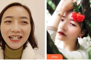 黃石中山口腔醫(yī)院楊勇軍整形價格表附牙齒隱形矯正案例展示