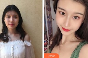 十堰海菲醫(yī)學美容診所劉海燕整形價格表附埋線提升案例展示