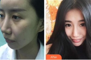 十堰梵媞醫(yī)學美容門診部李小燕整形價格表附埋線提升例展示