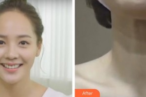 十堰陽光整形醫(yī)院邱銀先整形價格表附微針去頸紋案例展示