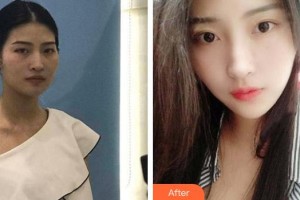 十堰民生婦科醫(yī)院醫(yī)學美容科鄭晉東整形價格表附埋線提升案例展示