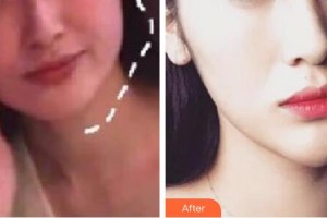 十堰東風總醫(yī)院整形激光美容科胡永璐整形價格表附埋線提升案例展示