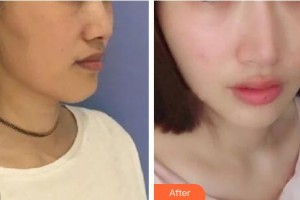 十堰市婦幼保健院整形美容中心蹇洪整形價格表附射頻緊膚案例展示