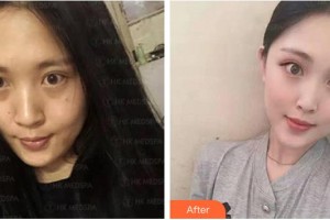 十堰太和醫(yī)院整形美容中心呂娟整形價格表附埋線提升案例展示