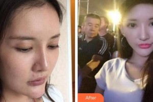 十堰市人民醫(yī)院整形美容燒傷外科王建國整形價格表附埋線提升案例展示