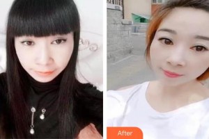 十堰愛爾眼科醫(yī)院李凌整形價格表附切眉術(shù)案例展示