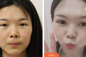 十堰愛爾眼科醫(yī)院黃濤整形價格表附眼部綜合案例展示