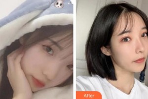 十堰愛爾眼科醫(yī)院張英朗整形價格表附上瞼提肌案例展示