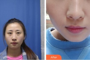 十堰愛爾眼科醫(yī)院吳建華整形價格表附激光去眼袋案例展示