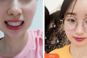 十堰東風口腔醫(yī)院陳麗榮整形價格表附牙齒隱形矯正案例展示