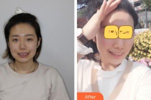 十堰東風口腔醫(yī)院龍明生整形價格表附牙齒隱形矯正案例展示