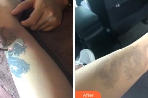 襄陽市中心醫(yī)院整形美容科胡強(qiáng)整形價(jià)格表附激光去紋身案例展示