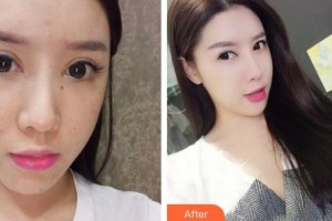 襄陽市中心醫(yī)院整形美容科姚春蓮整形價(jià)格表附激光祛斑案例展示