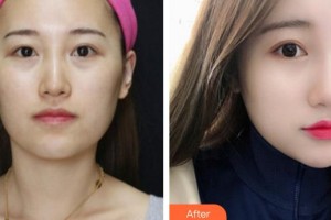 襄陽美嘉伊整形美容醫(yī)院陳明亮整形價(jià)格表附激光祛斑案例展示