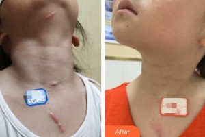 襄陽市中心醫(yī)院整形美容科王琦整形價格表附激光祛疤案例展示