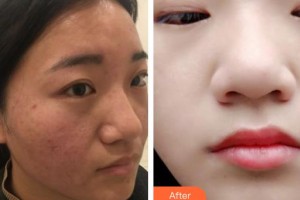 襄陽韓美醫(yī)療美容醫(yī)院王娜整形價格表附去痘印痘坑案例展示