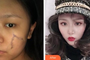 襄陽市中心醫(yī)院整形美容科謝群整形價格表附激光祛疤案例展示