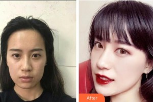 襄陽市中心醫(yī)院整形美容科靳軍華整形價格表附無針水光案例展示