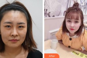 襄陽市中心醫(yī)院整形美容科惠祖燕整形價格表附彩光嫩膚案例展示