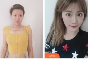 襄陽海峽醫(yī)療美容門診部吳新建整形價格表附激光祛疤案例展示