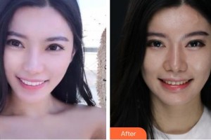 襄陽伊萊美醫(yī)療美容醫(yī)院沈?qū)W洙整形價格表附美白貼片案例展示