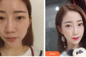 襄陽維多利亞醫(yī)療美容醫(yī)院洪星杓整形價格表附鼻部綜合案例展示