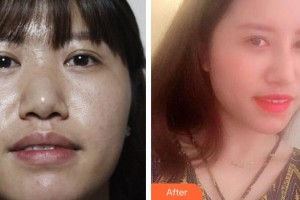 襄陽華美醫(yī)療美容門診部段麗萍整形價格表附鼻部綜合案例展示