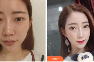 襄陽華美醫(yī)療美容門診部張輝整形價格表附假體隆鼻案例展示