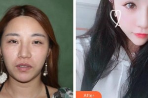 襄陽德爾美客西子醫(yī)療整形美容門診部趙裴整形價格表附鼻部綜合案例展示